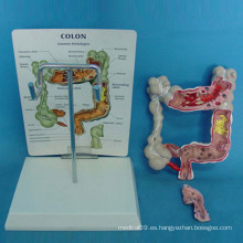 Modelo anatomopatológico de anatomía del colon humano para la enseñanza médica (R100201)